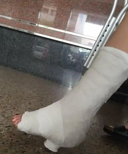 为什么骨折后每天都有一段时间有肿胀感?