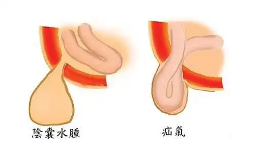 症状:阴囊肿大,透光