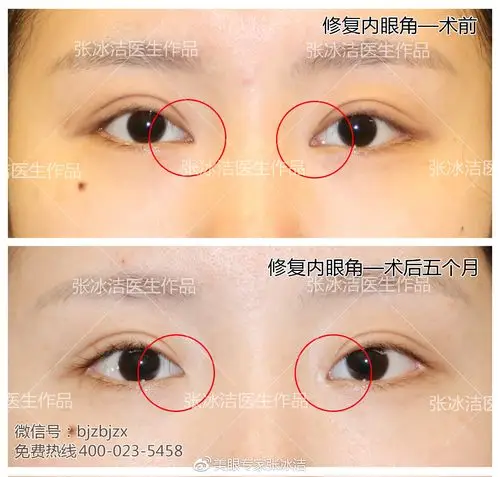 内眼角开大失败各种修复案例汇总张冰洁