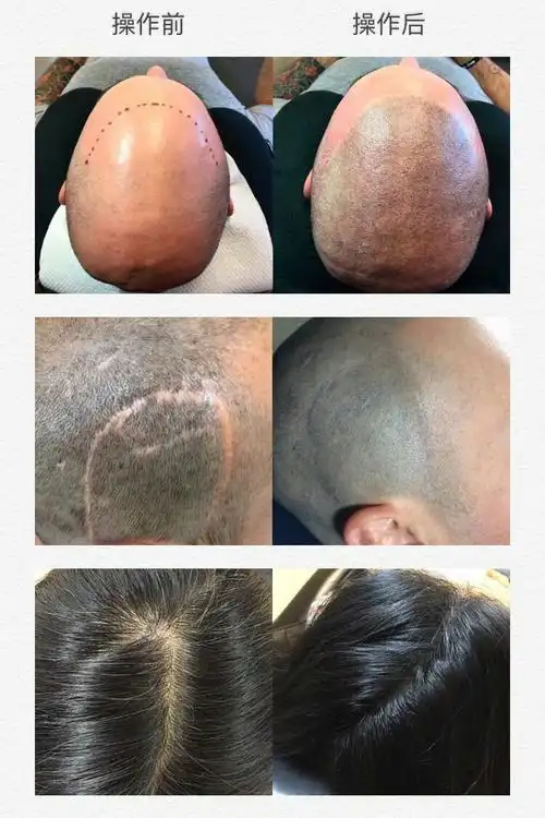纹发技术是利用专用色素在头皮上伪装成黑色的毛囊,使脱发的人看起来