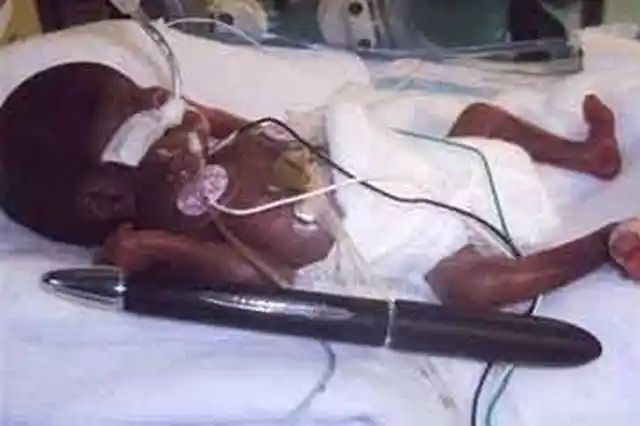 世界上"最小的婴儿"只有巴掌大,现在怎么样?网友:想不到