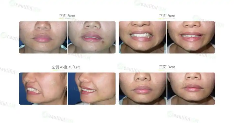 嘴唇功能性矫正