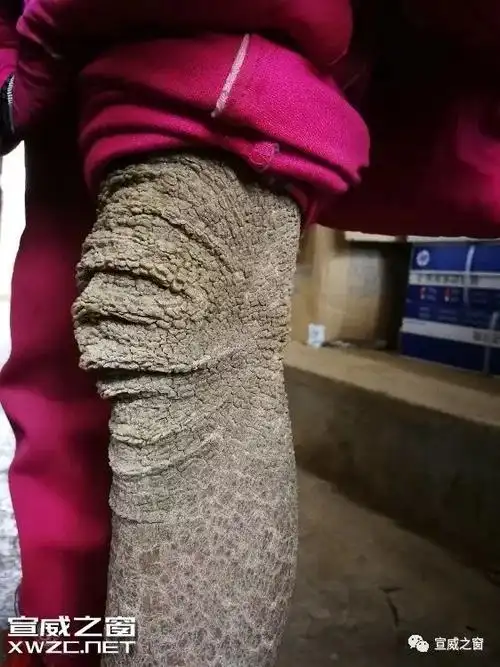 宣威一小女孩得了皮肤怪病像树皮