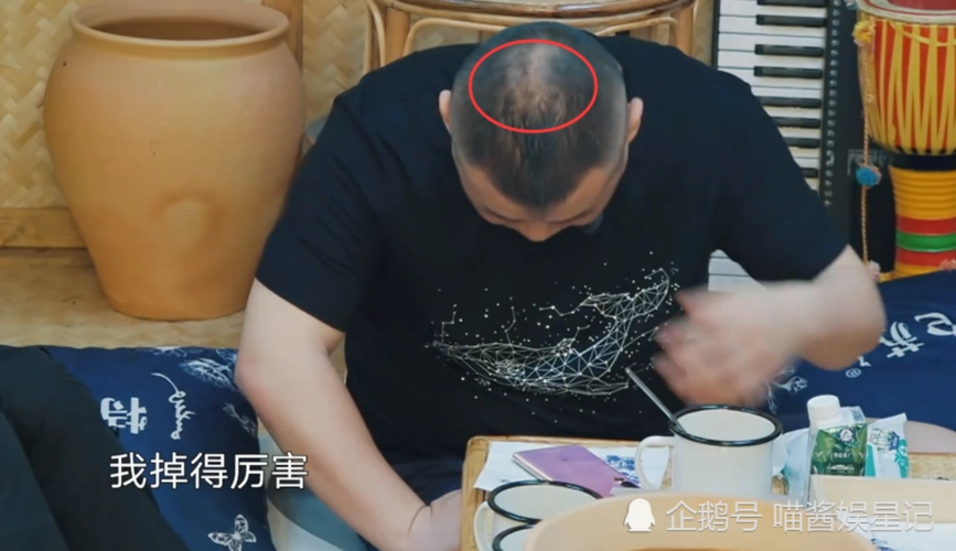 岳云鹏脱发严重已秃顶,不敢相信周深发量多,质疑:你戴