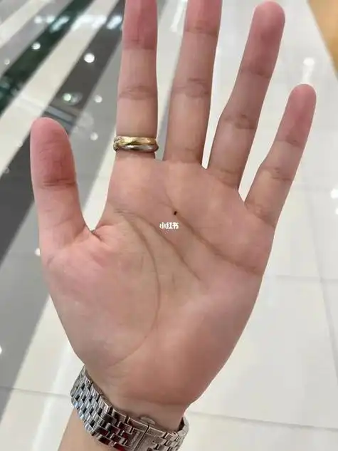 手掌痣深度:若手心痣深而明显,则表示能抓住机遇,财运好,而浅色手心