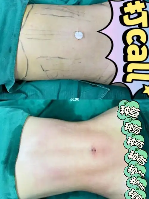 威塑腰腹环吸_腰腹_环吸_吸脂_减肥_减肥医药