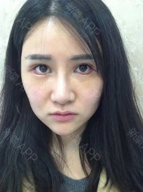 【下眼睑下至 开外眼角——术后第七天】