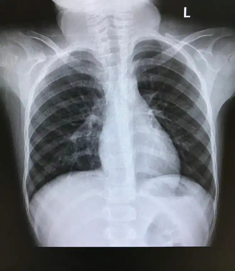 标准胸部x线摄影图片