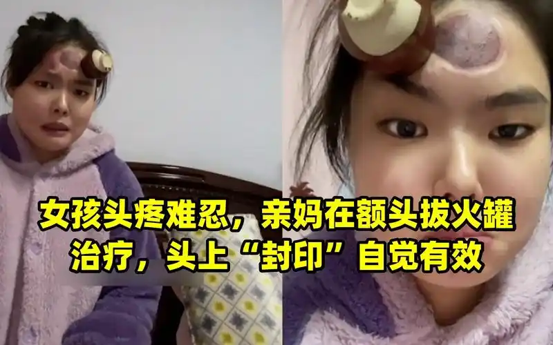 女孩头疼难忍,亲妈在额头拔火罐治疗,头上"封印"自觉有效