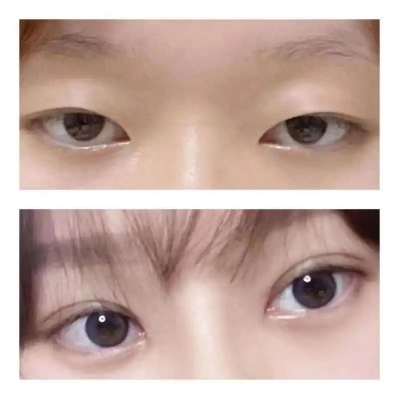 小姑娘25天的双眼皮,后悔了~早点做就好了,虽然还处于尴尬期,但是眼睛