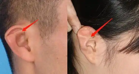 最后来跟大家港一下,面对这些"不标准"的耳廓有哪些解决办法,也就是