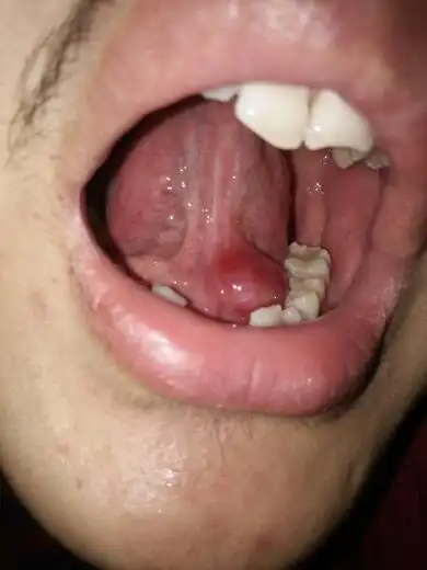 舌头下面肿的是怎么了