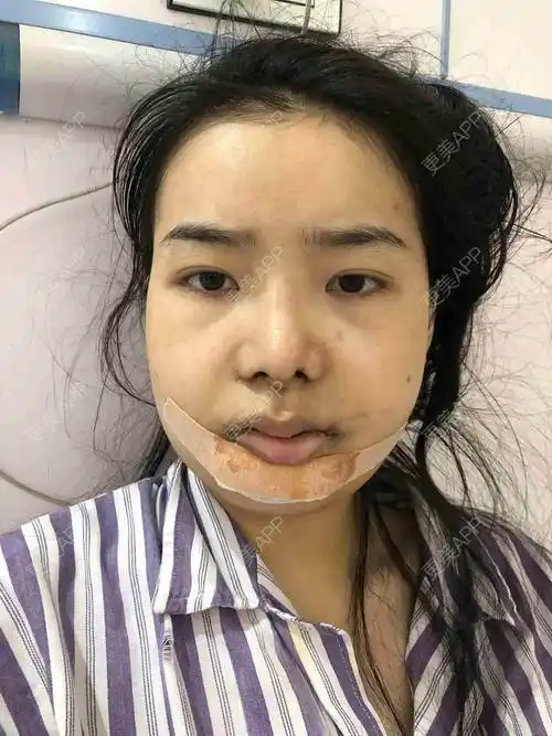 更美用户hxrrseovpt的凸嘴矫正日记 | 赣州 | 凸嘴矫正 | 正颌手术