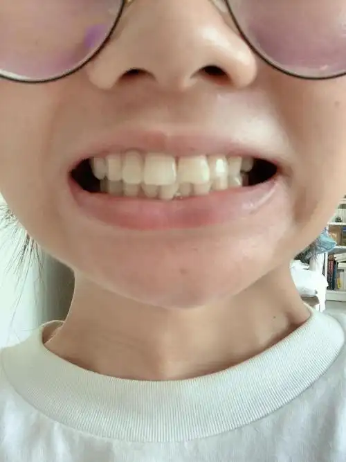 【帮看】姐妹们,请大家帮我看看我需要箍牙吗?