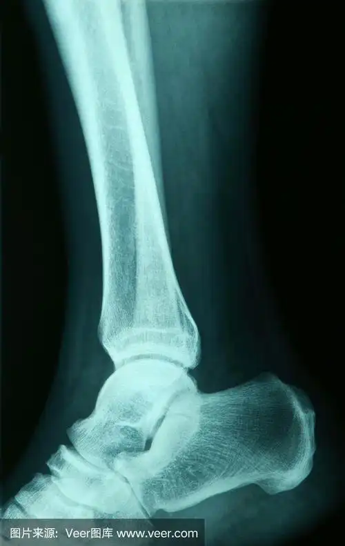 足部的x光图像.