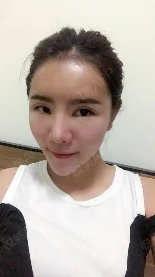 【深圳利美康西一诺脂肪填充】【第4天】今天感觉脸比前面几天还要肿