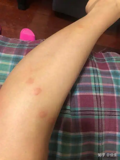 被跳蚤咬的全身都是包是什么样的感受! - 知乎