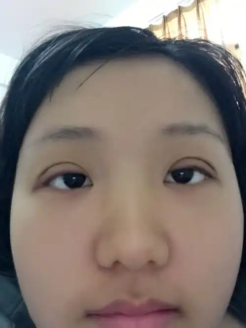 割完双眼皮一周后的宽度和一个月后的宽度会一样么?还是会变窄点?