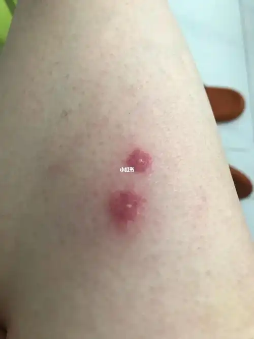 被跳蚤咬了,怎么止痒?_止痒_药店_医疗健康_医疗健康其他