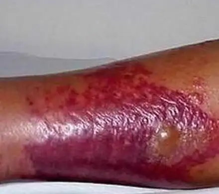 丹毒必要与哪些病相区别