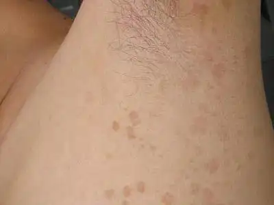 脖子腋下白黑色色斑点汗斑花斑癣,胸前背后胳膊也有