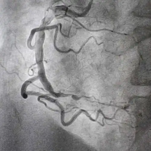 支架置入术前:右冠状动脉远端闭塞病变