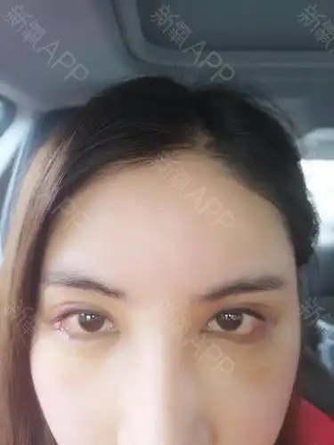 开外眼角好不好_效果图_cinderellazy开外眼角术后第7天_新氧美容整形
