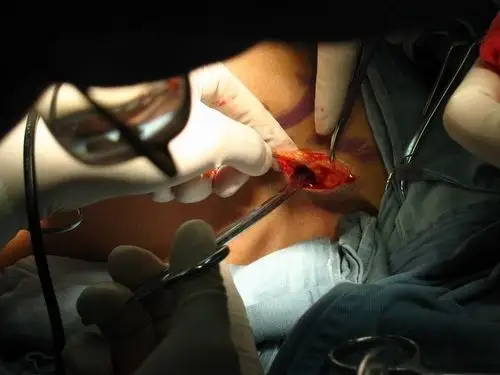 《我要做女人》——变性手术