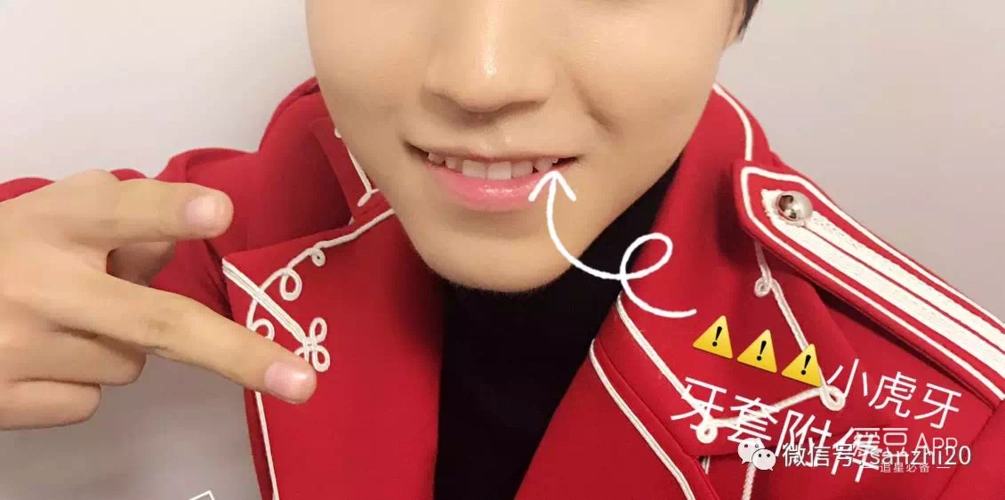 [tfboys][盘点]170323 王俊凯戴牙套了,虎牙还会有吗?