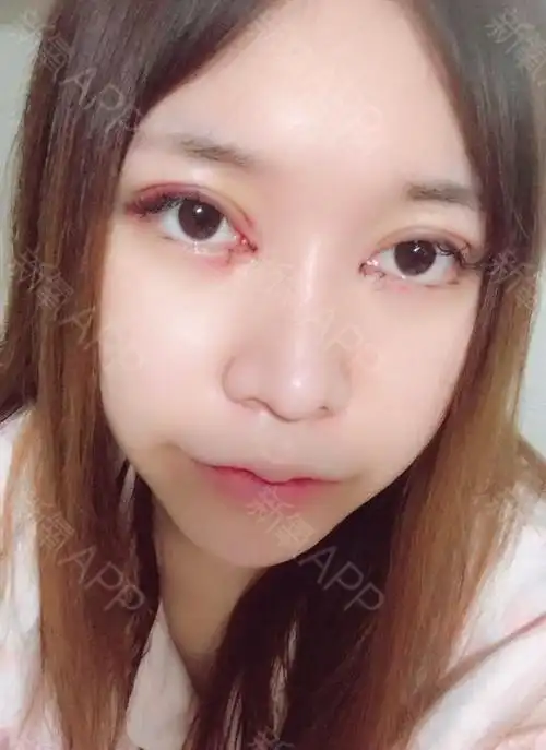 新氧- kakin | 眼部 | 开眼角 | 双眼皮 | 开内眼角 | 埋线双眼皮