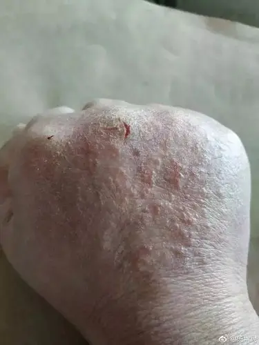 致敬!这双"丑陋无比的手"让无数网友动容