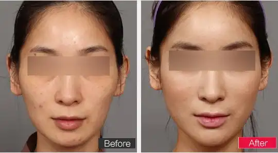 自体脂肪面部填充手术特点如下