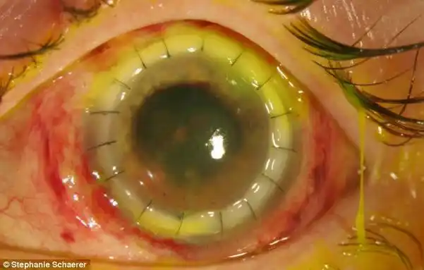 恐怖慎入!隐形眼镜致英女子摘除眼球