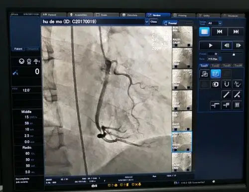 为生命护航,为技术喝彩 ——瓮安县人民医院成功开展首例急诊冠状动脉
