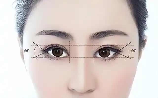 医美科普:眼睛小该怎么办?有什么手术方式可以做开眼角?