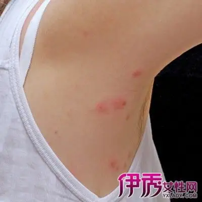【图】观察跳蚤咬人的症状图片 分享预防被咬的9大措施