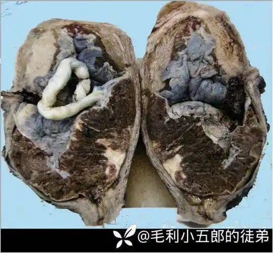 产科一图植入性胎盘图片