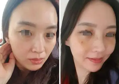 前后对比效果如果是为了后期吸收效果单次填充较多脂肪应该如何处理?