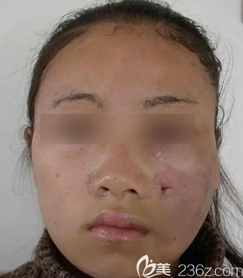 面部吸脂失败图片