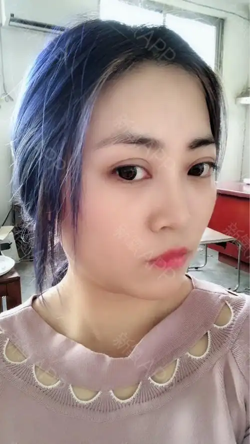 感觉刚过年没多久,割完双眼皮已经三个月了,再记录一_圈子-新氧美容