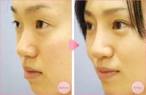 隆鼻手术前后对比,假体隆鼻,韩式隆鼻,膨体隆鼻,玻尿酸隆鼻,非手术