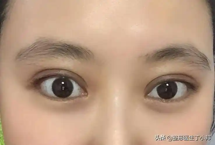 全切双眼皮太宽,太假,双眼皮肉条感明显怎么办?_处理_眉眼_组织