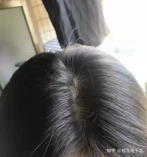 头顶秃掉发多头皮毛囊油脂超级多怎么才能减少掉发