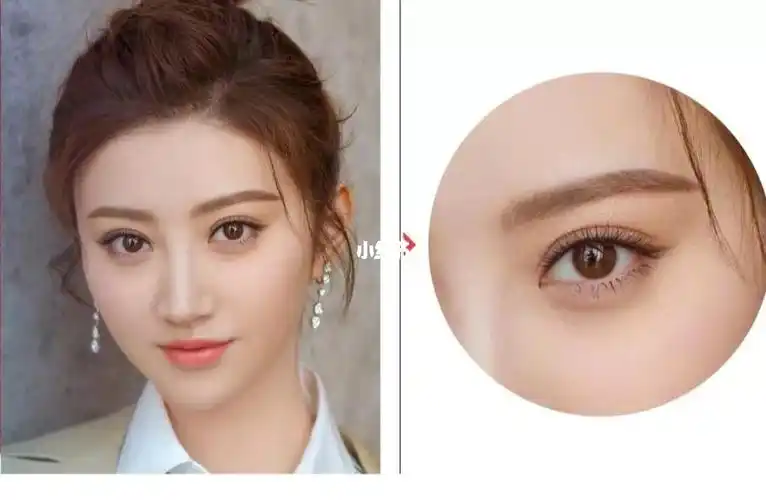 什么是平行型双眼皮?