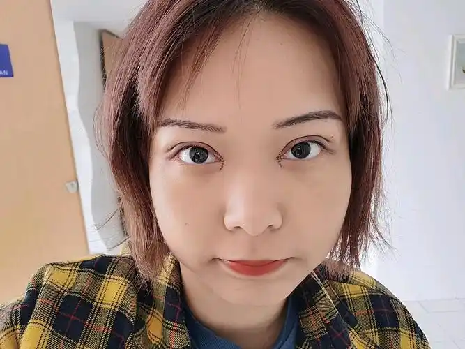 做双眼皮 开眼角的第一天,纪念一下