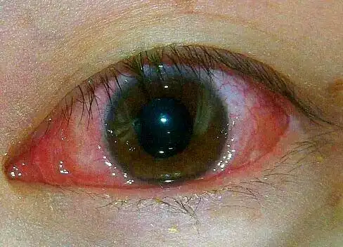 眼睛出血了看着好吓人到底是怎么了