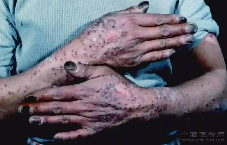 密集恐惧症及非医护人员慎点!史上最全的皮肤病图谱来了(修订版)!