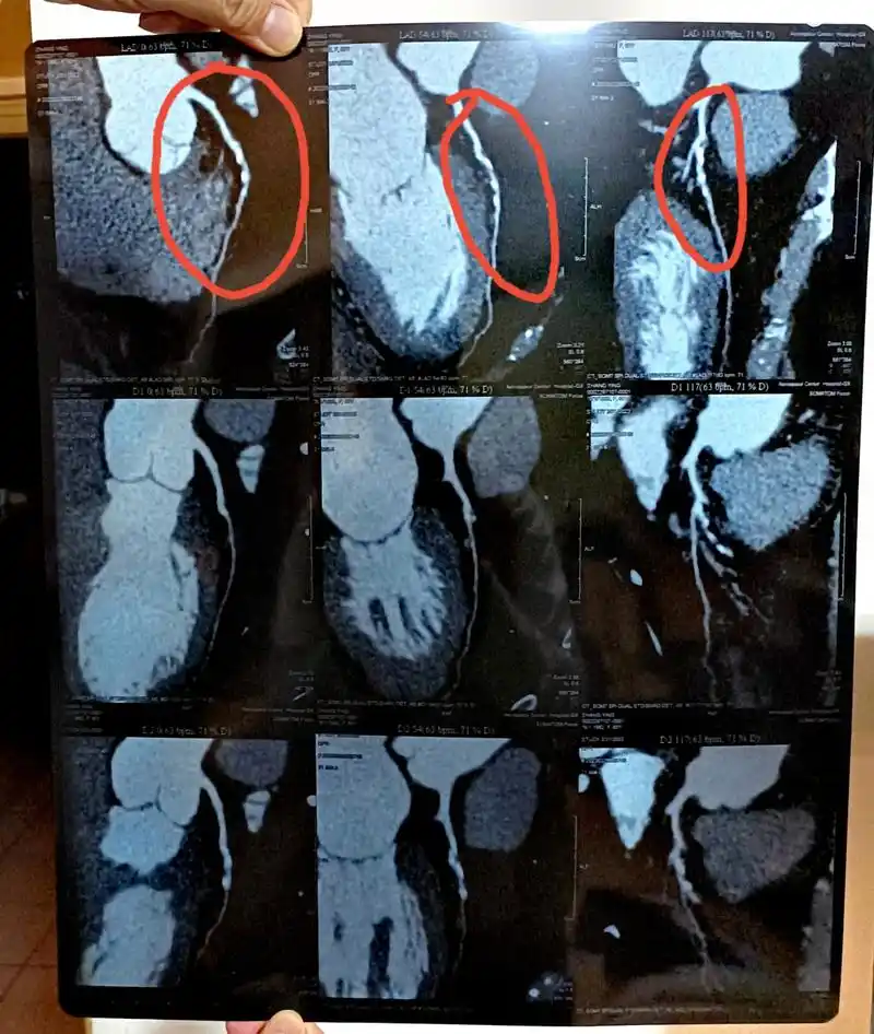 我做了心脏冠脉ct,报告显示:左前降支中段管壁可见钙化,非钙化斑块,管