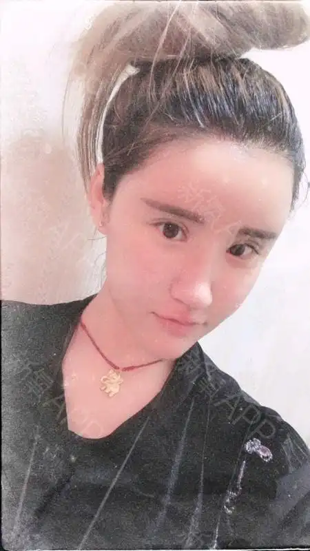 自体脂肪填充全脸,术后一个月脂肪移植效果,是不是很想看看我最近恢复