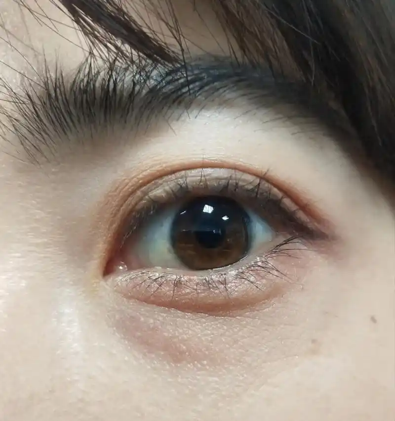 我才30岁,眼珠子为什么这么黄难道我老了 不知道什么原因,很小的时候